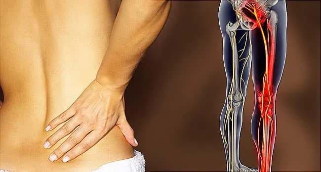 Sciatica Relief Guide Causes Symptoms Treatment and Prevention